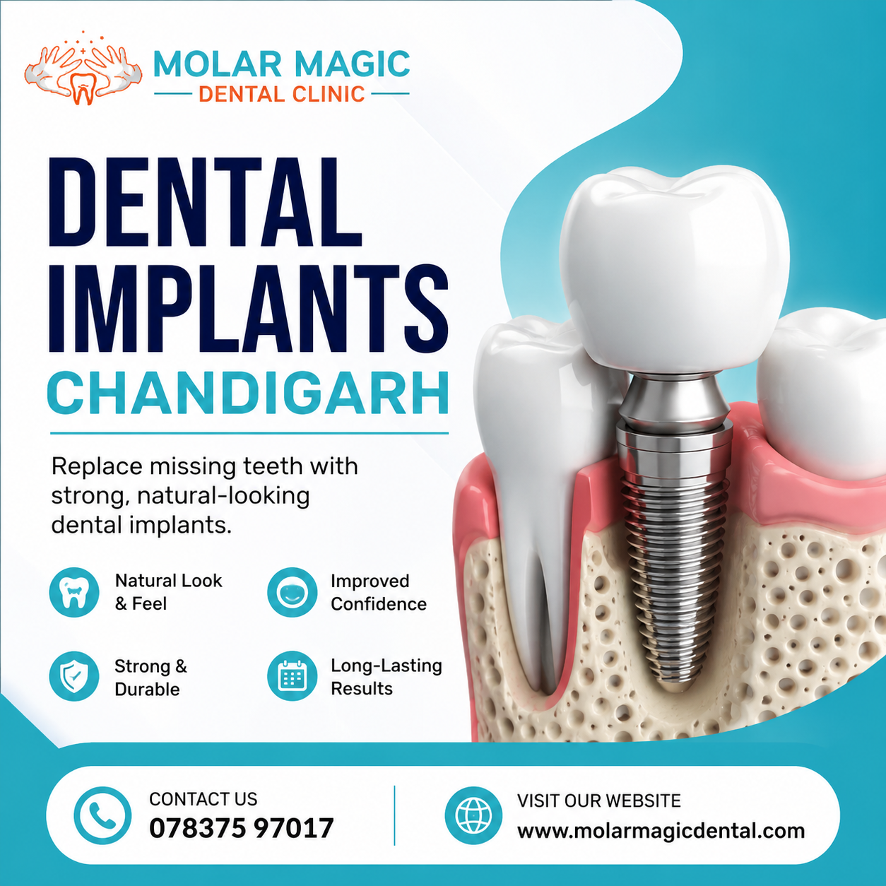 Molar Magic Dental Clinic - Best Dental Clinic in Chandigarh - Dental Implants in Chandigarh Starting Rs. 15,000